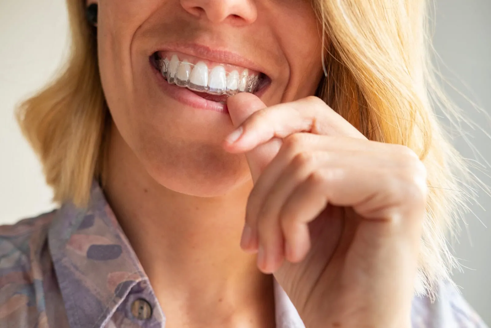 Close-up of clear aligner trays