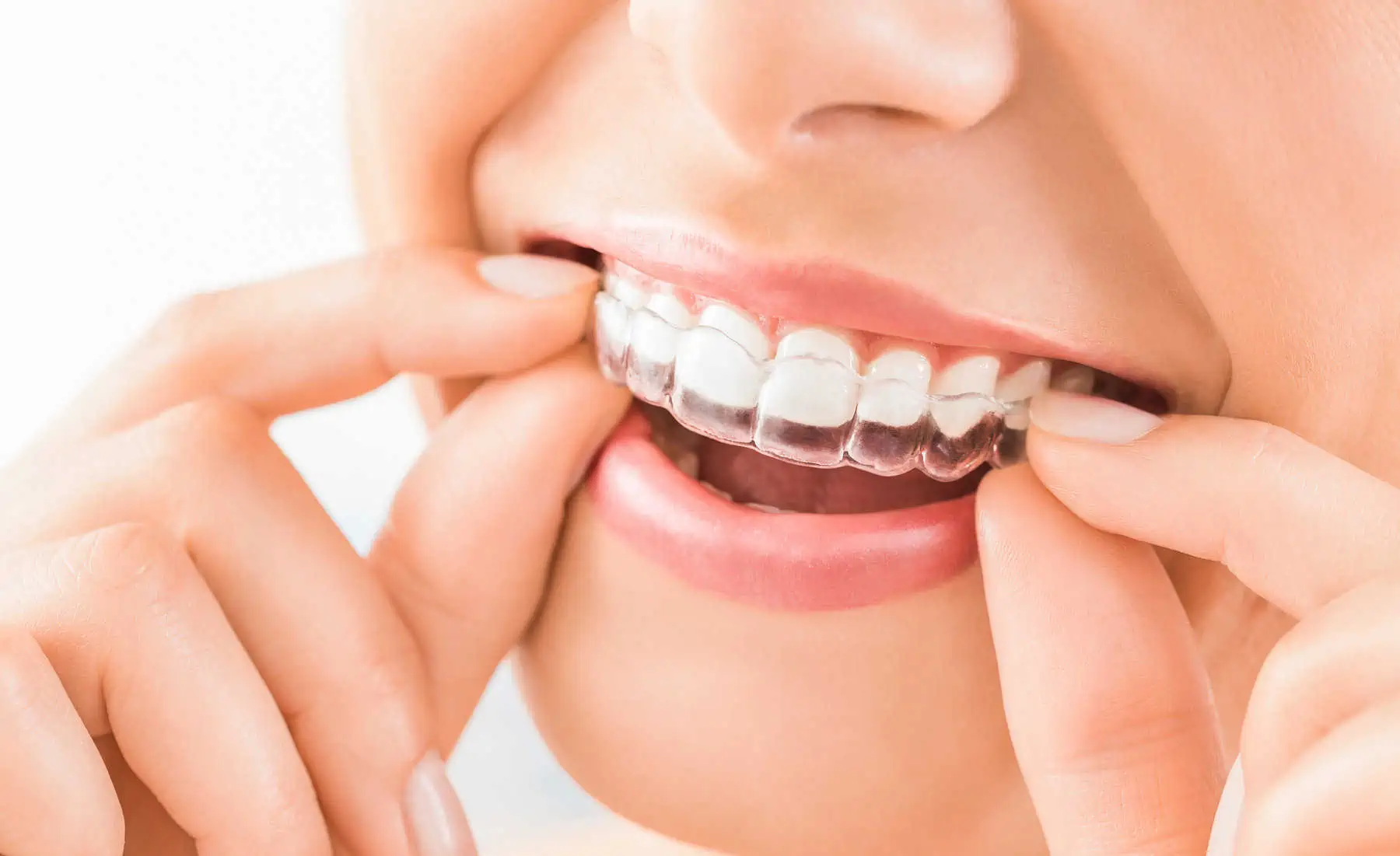 Woman holding a clear Invisalign aligner tray and smiling