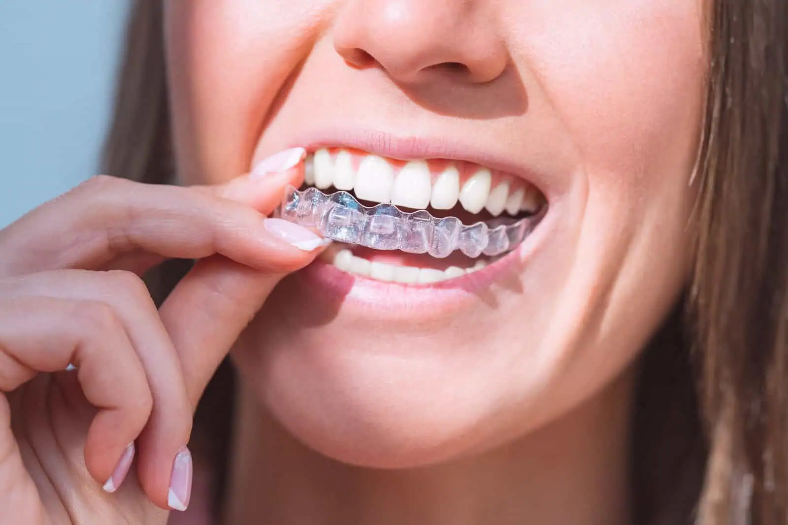 Patient placing a clear Invisalign aligner